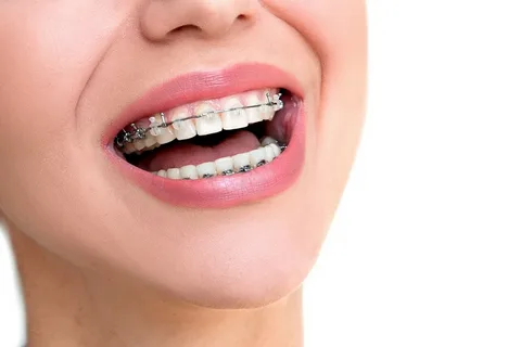 dental braces treatment in Lahore