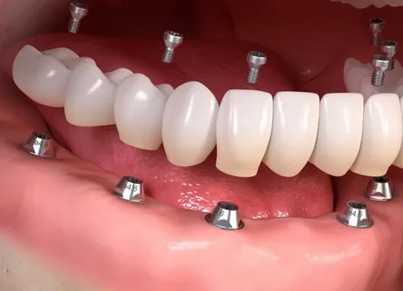 Implant and Aesthetics