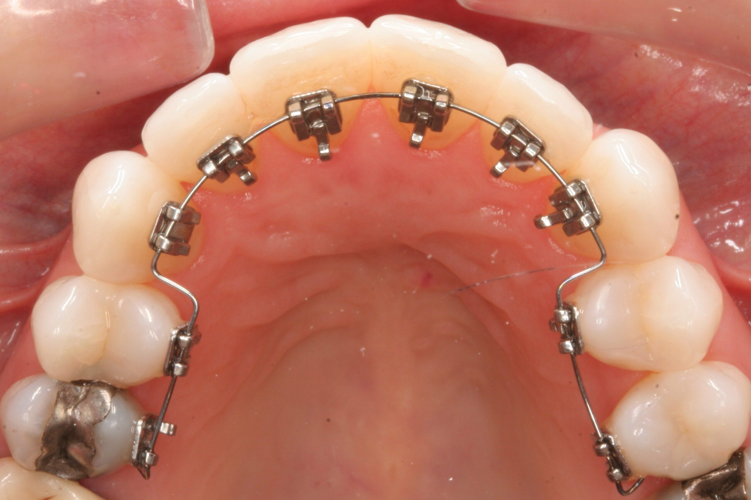 dental braces treatment in Lahore