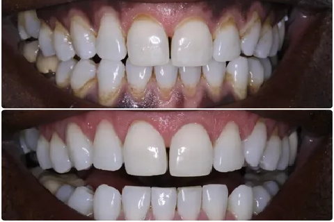 gum pigmentation treatment cost