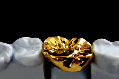 Gold Dental Crown