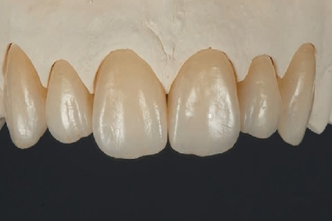 Zirconium Crown Treatment in Lahore