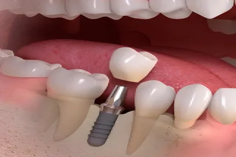 worn teeth treatment