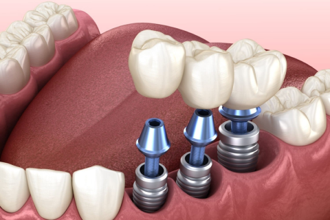 root canal treatment