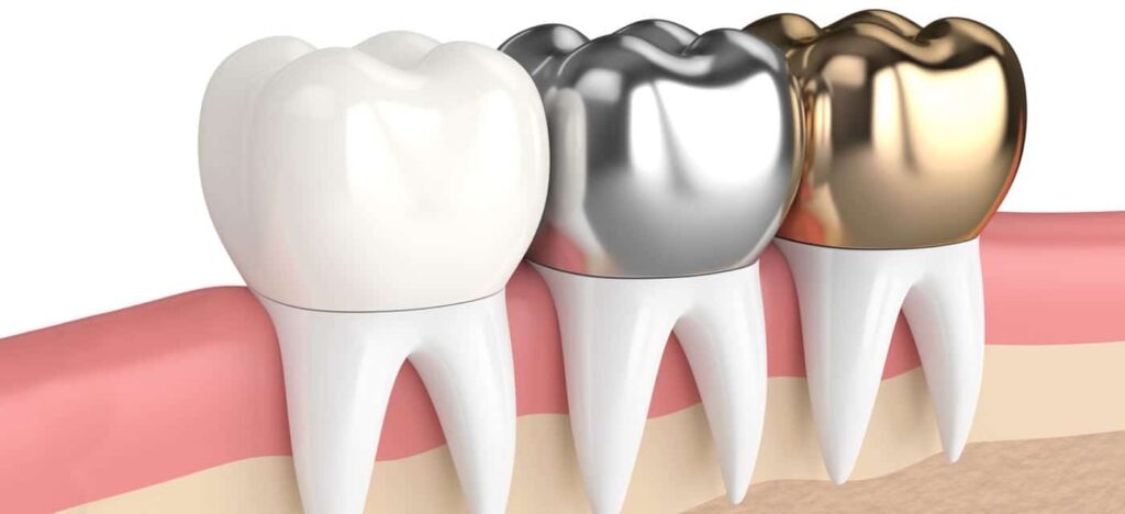 Choosing the Right Dental Filling: Understanding Your Options