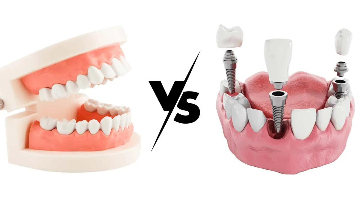 Dental Implants vs dentures