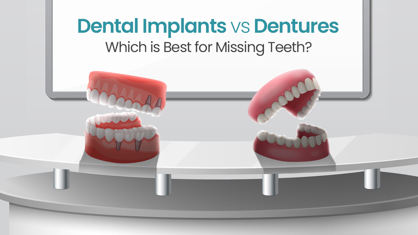 Dental Implants vs dentures