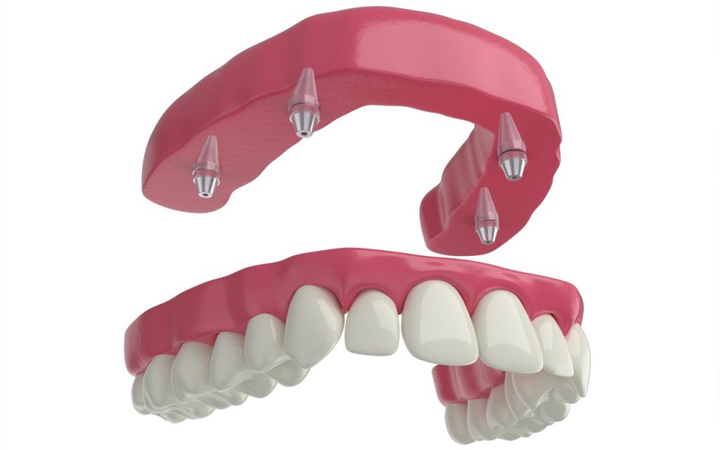 Single tooth implant vs full mouth implant