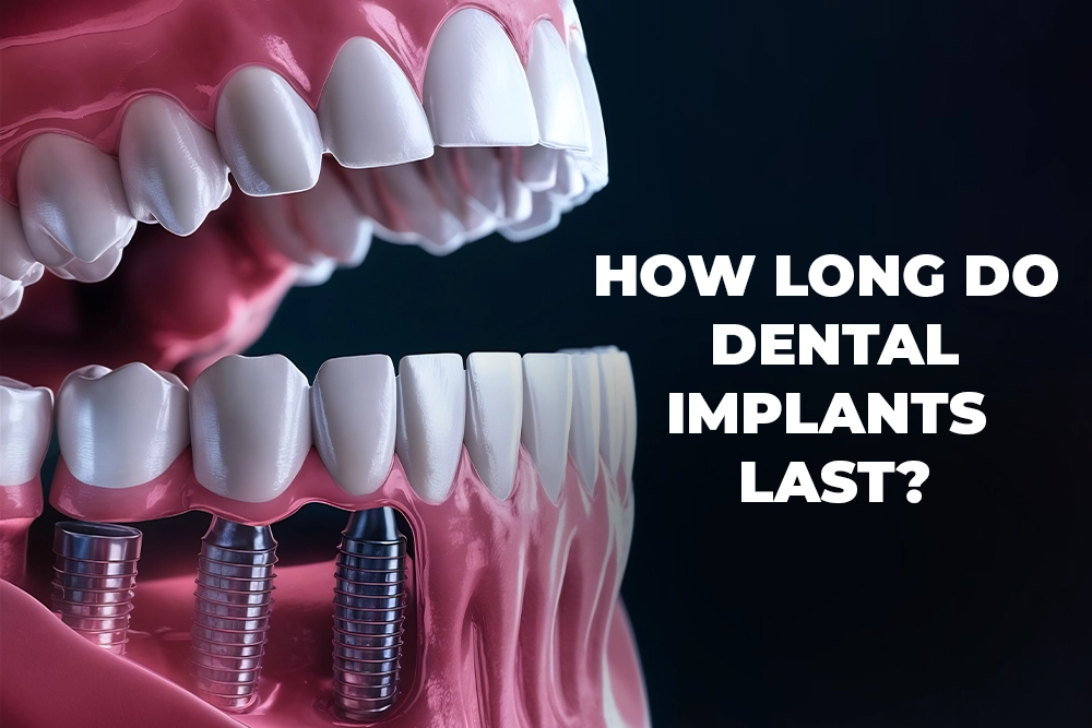 How Long Do Dental Implants Last? Tips for Longevity