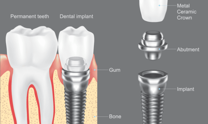 process of dental implants