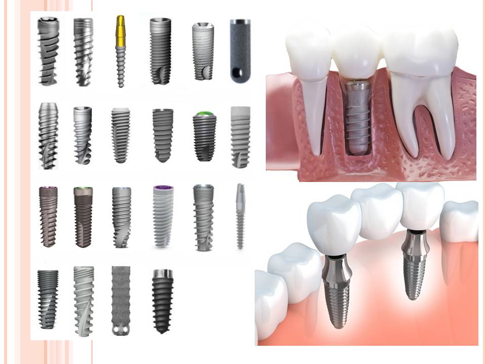 how long do dental implants last