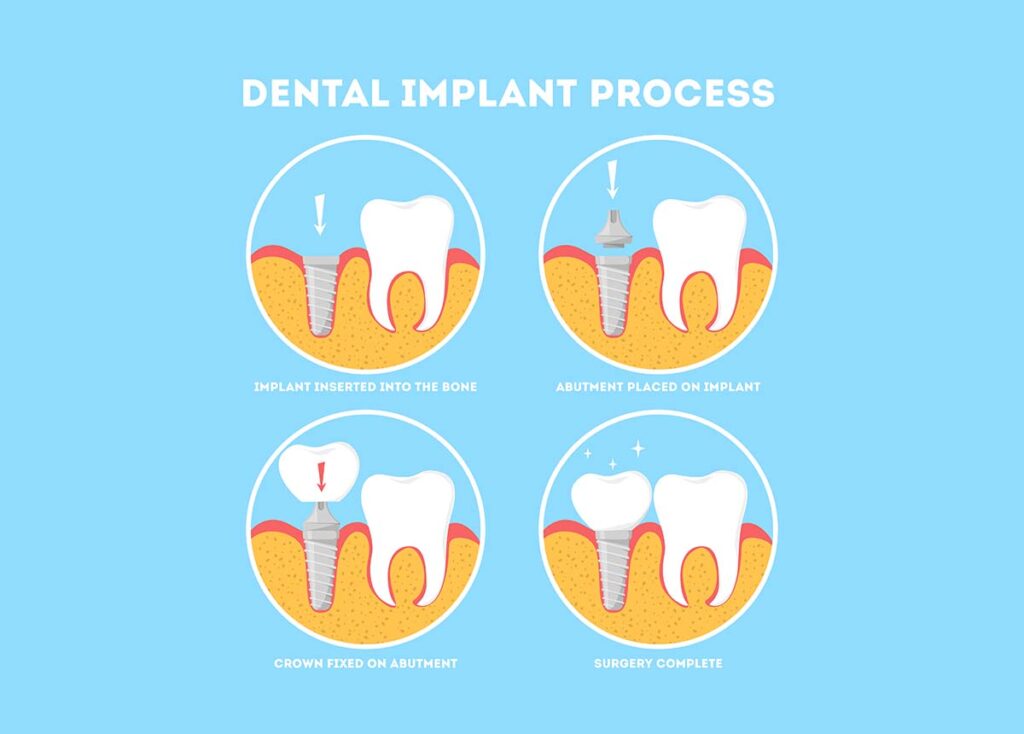 Step-by-Step Process of Dental Implants: What to Expect