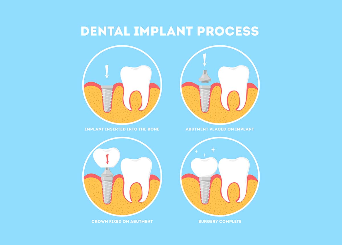 process of dental implants