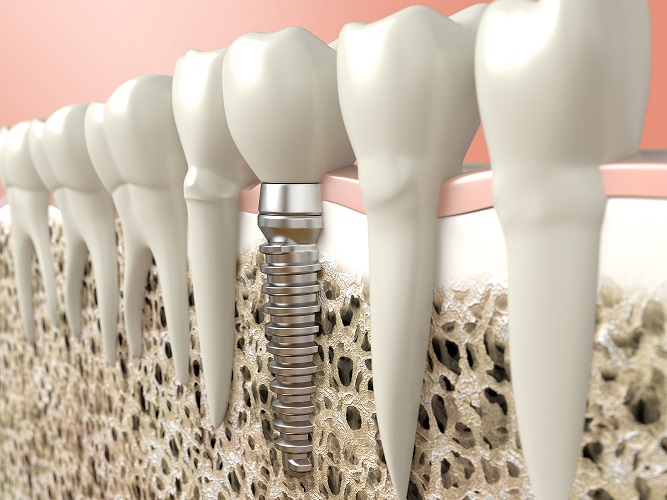 How long do dental implants last