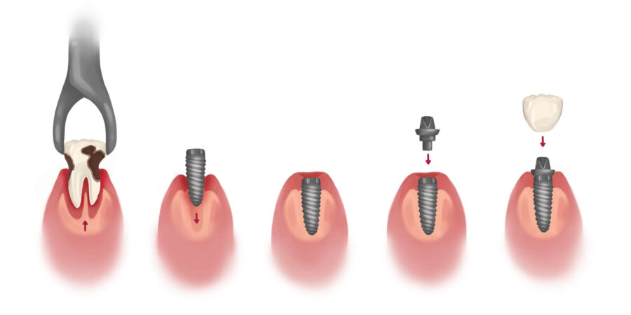 process of dental implants