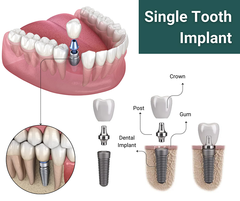 Single tooth implant vs full mouth implant