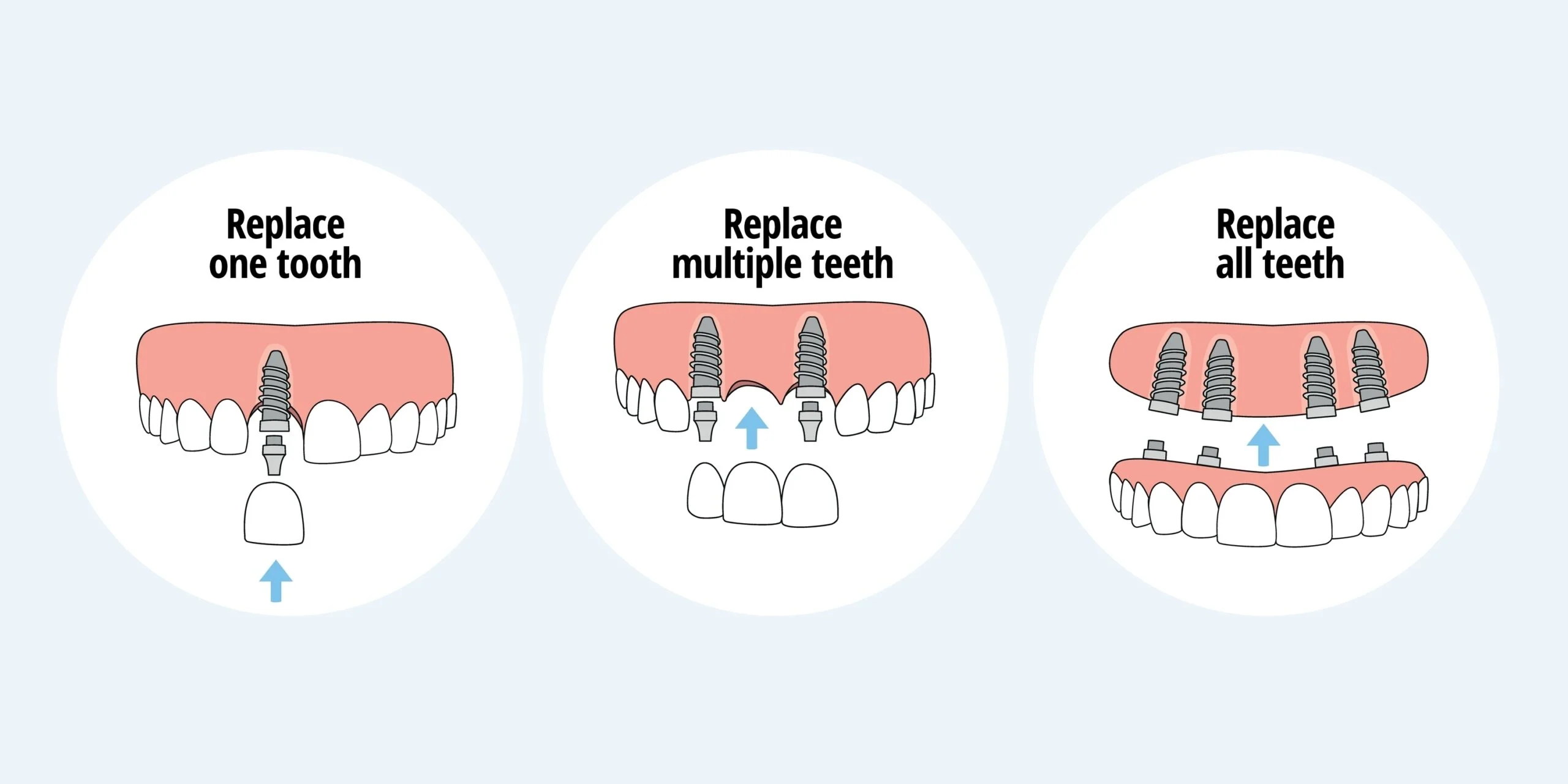 Single tooth implant vs full mouth implant