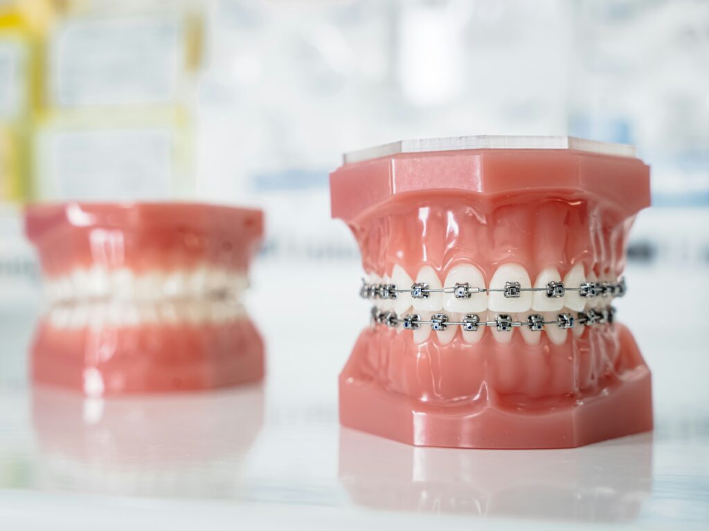 Common Braces Problems and How to Fix Them